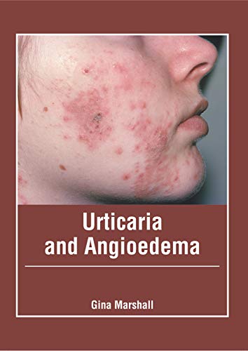 Urticaria and Angioedema [Hardcover]