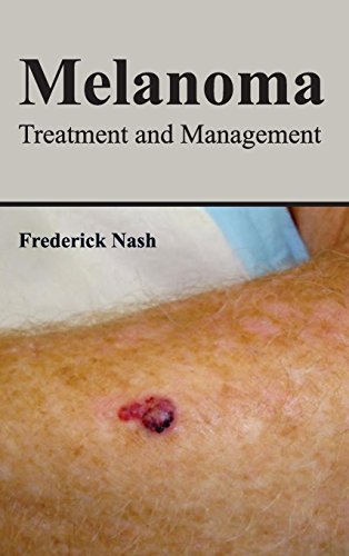 Melanoma Treatment And Management [Hardcover]