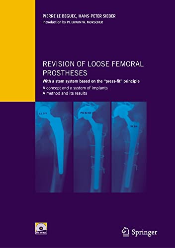 Revision of loose femoral prostheses with a stem system based on the  press-fit  [Mixed media product]