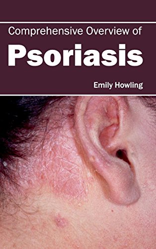 Comprehensive Overview Of Psoriasis [Hardcover]