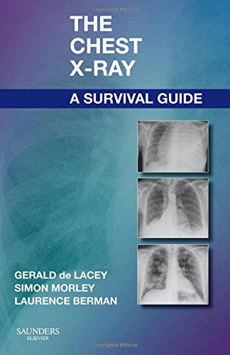 The Chest X-Ray A Survival Guide [Paperback]