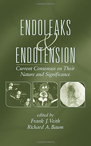 Endoleaks and Endotension Current Consensus on Their Nature and Significance [Hardcover]
