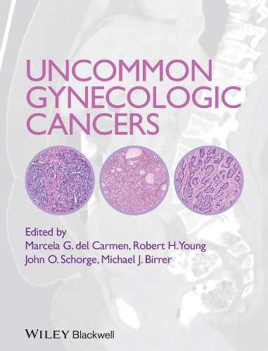 Uncommon Gynecologic Cancers [Hardcover]