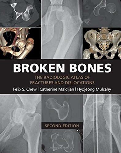 Broken Bones The Radiologic Atlas of Fractures and Dislocations [Paperback]