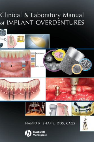 Clinical and Laboratory Manual of Implant Overdentures [Hardcover]