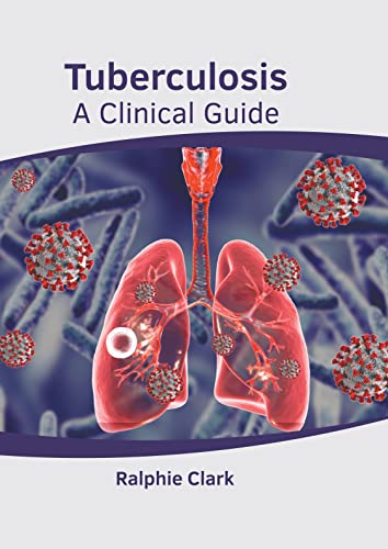 Tuberculosis A Clinical Guide